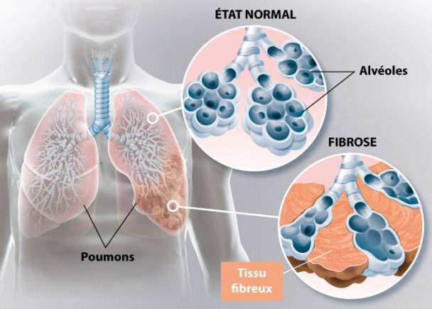 Fibrose pulmonaire idiopatique