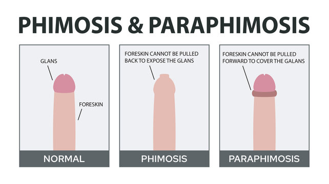 Phimosis - Paraphimosis