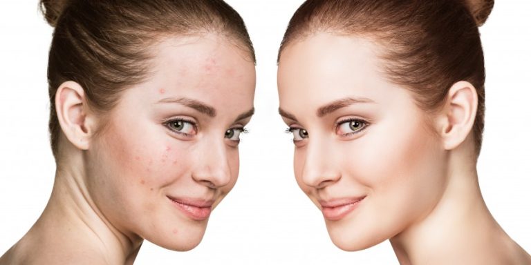 Eliminer les cicatrices d'acné